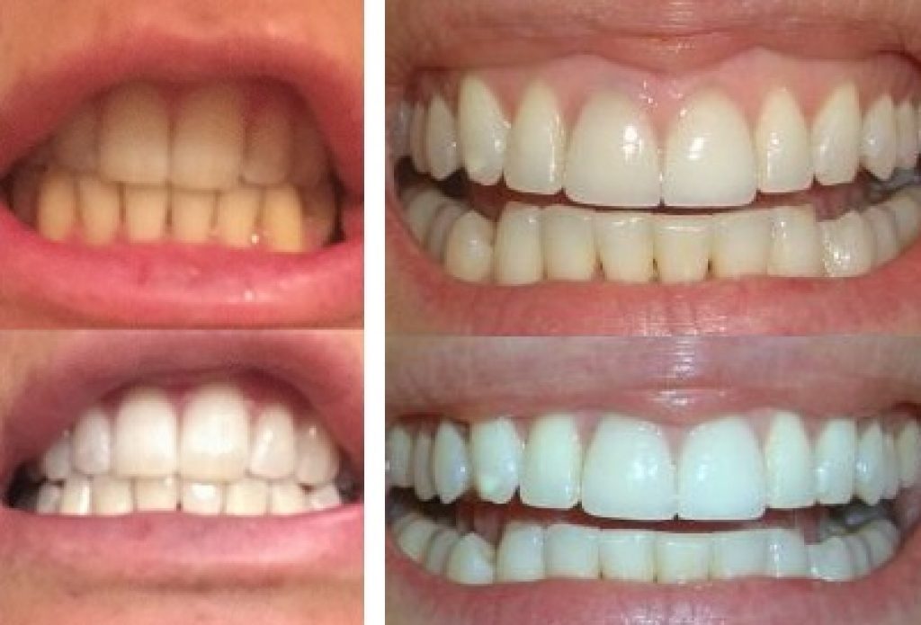 Före och efter användning av Dentway tandblekning