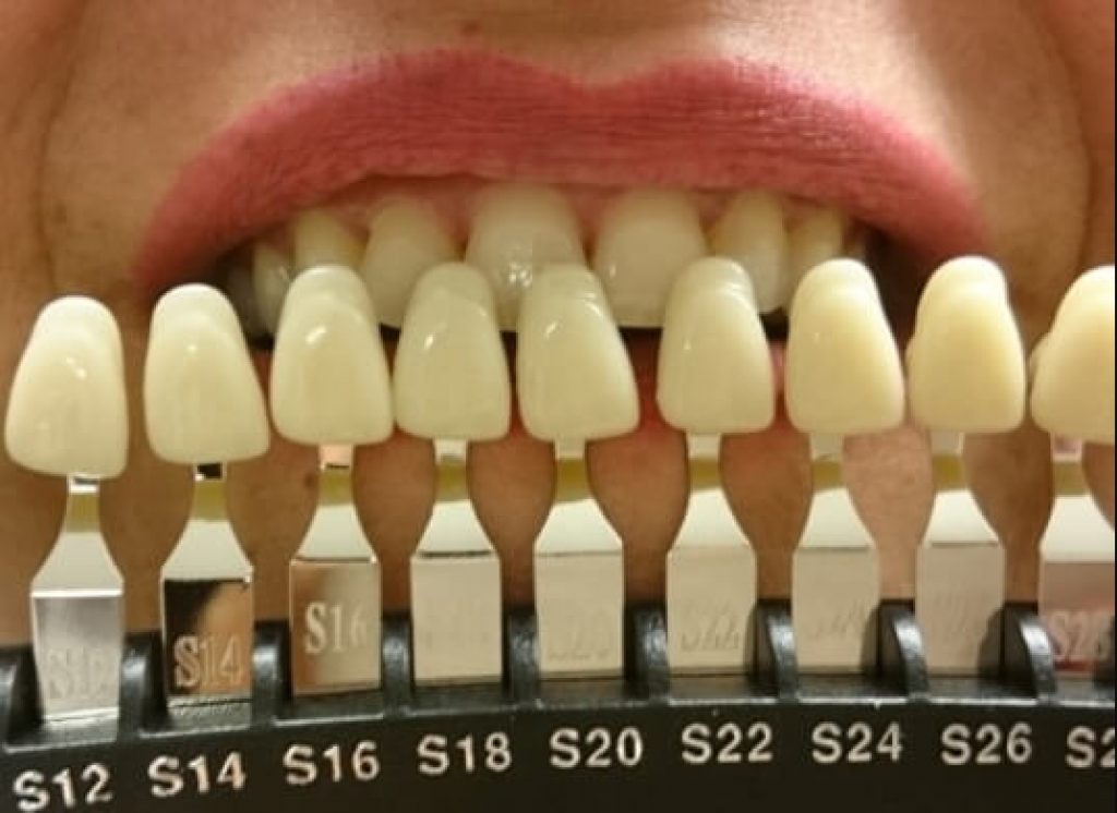Förebild på tänder med Dentway Starter Kit