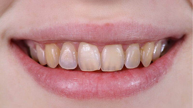 Om du bleker tänderna med bakpulver blir de först vita, sedan ser de ut såhär.
