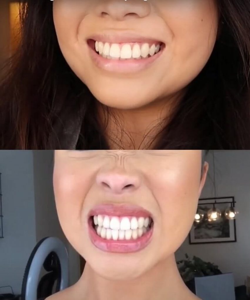 Kvinna bleker tänderna med tandbleknings strips