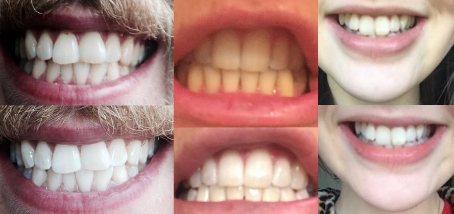 resultat efter att ha blekt tänderna med tandblekning och skena