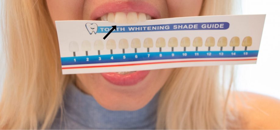 Test och omdömen av Confidentsmiles tandblekning - ger ett vitt resultat efter sju dagar!