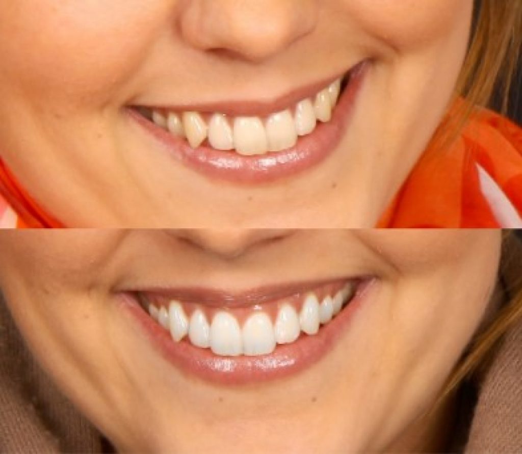 Vinnare av Vita Tandens jämförelse av tandblekning