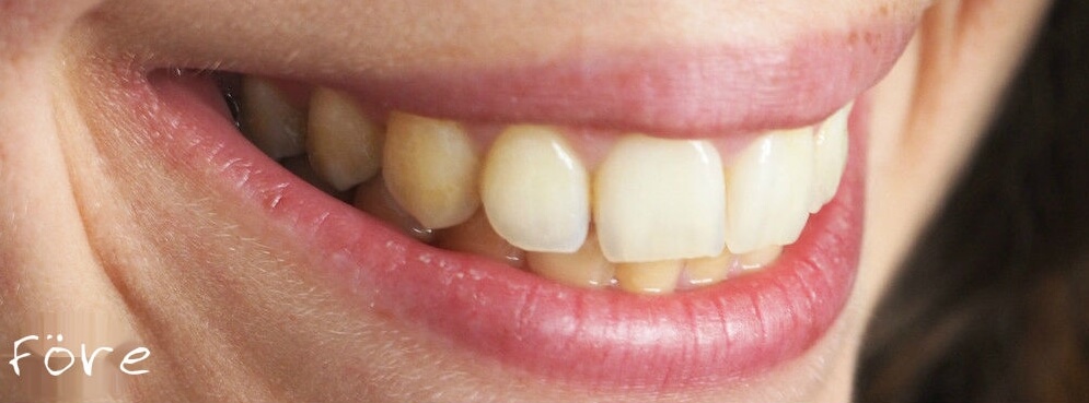 Tildes tänder innan Simplesmiles tandblekning