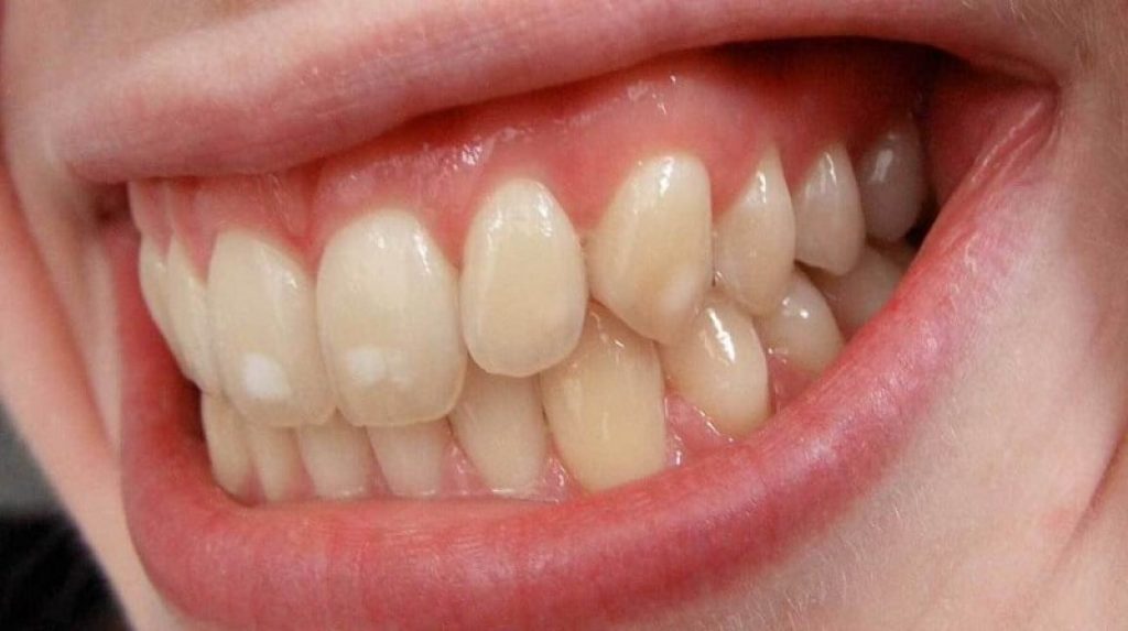 Tänder med vita fläckar