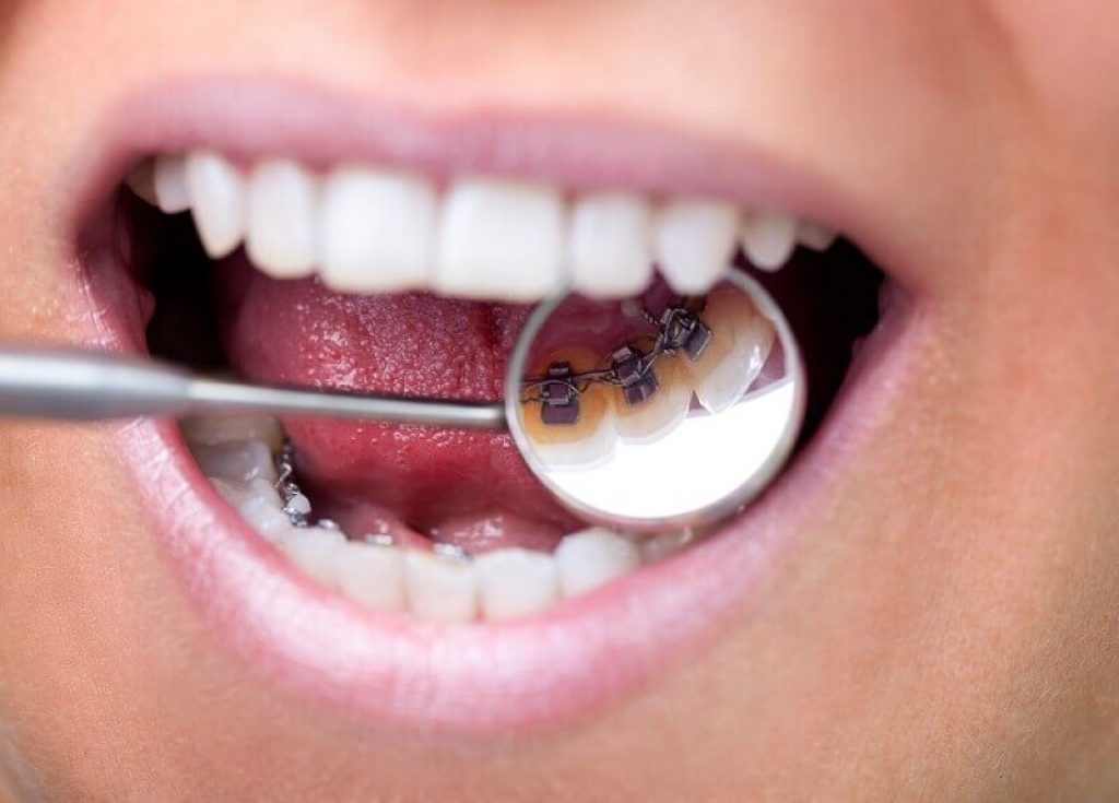 Spegel i munnen som visar tandställning