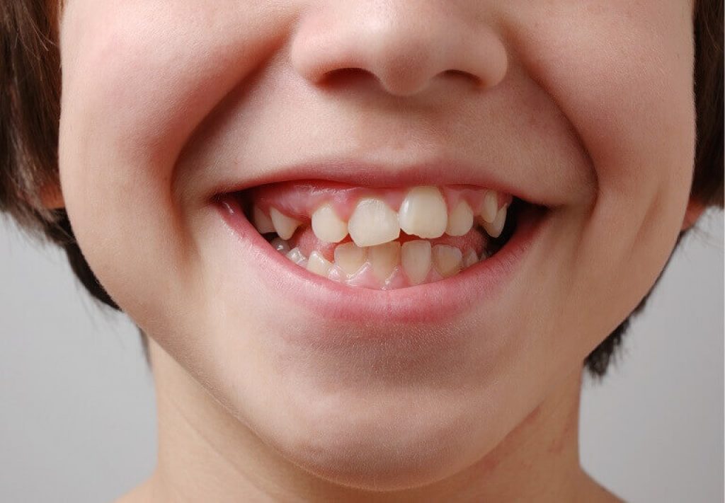 Barn som ler med sneda tänder